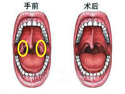 宝宝得了化脓性扁桃体炎不一定要输液